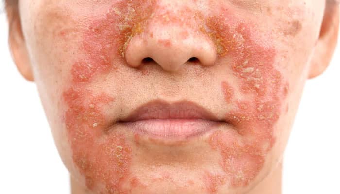 درماتیت سبوره (درماتیت سبورئیک) چیست؟ علائم و راه درمان آن