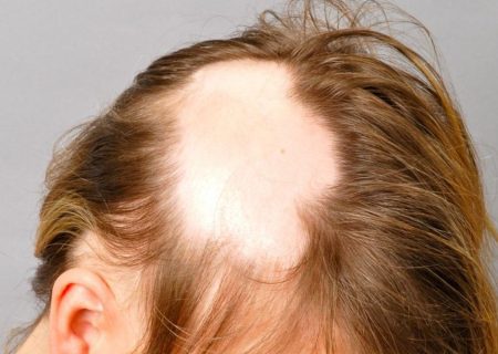 وسواس کندن مو یا تریکوتیلومانیا چیست؟