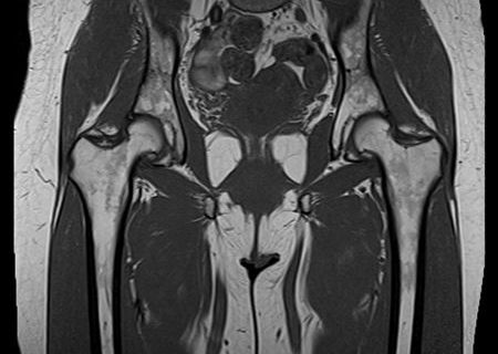 ام آر آی مفصل هیپ چیست و چه زمانی لازم است؟