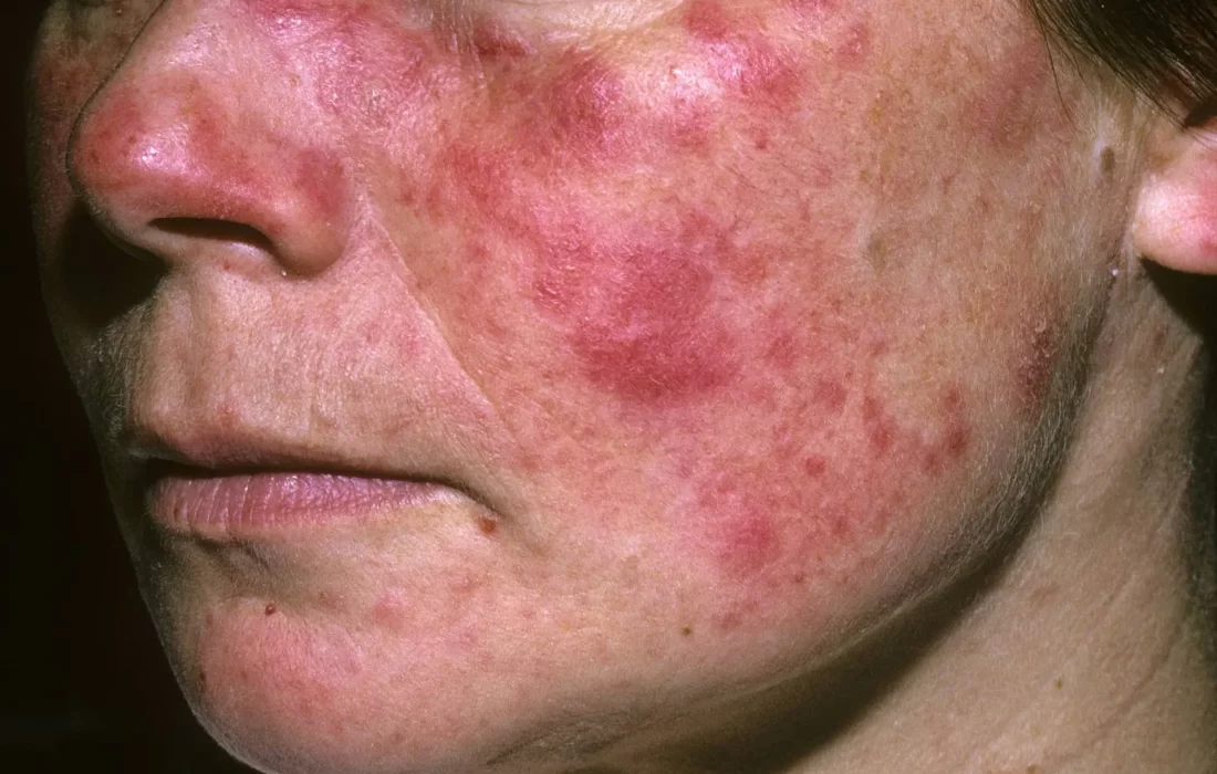 لوپوس پوستی چه علائمی دارد؟ بررسی روش مقابله و درمان آن