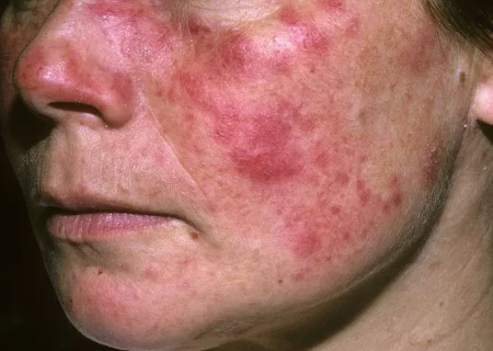 لوپوس پوستی چه علائمی دارد؟ بررسی روش مقابله و درمان آن