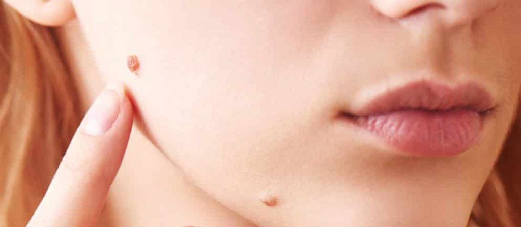 پاتولوژی خال چیست؟ آزمایشی برای تشخیص زودهنگام سرطان