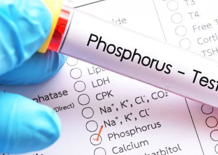 آزمایش فسفر (P) و تفسیر نتیجه آن