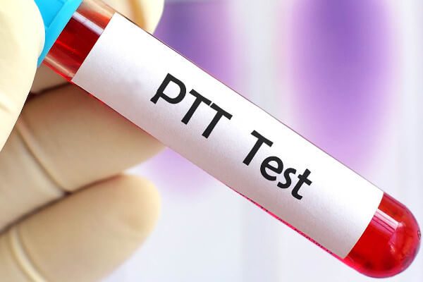 آزمایش PTT چیست و چه زمانی تجویز می‌شود؟