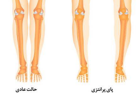 پاهای پرانتزی چیست و چگونه قابل تشخیص است؟