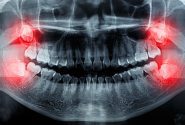 باورهای غلط در مورد دندان عقل