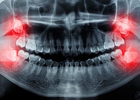 باورهای غلط در مورد دندان عقل