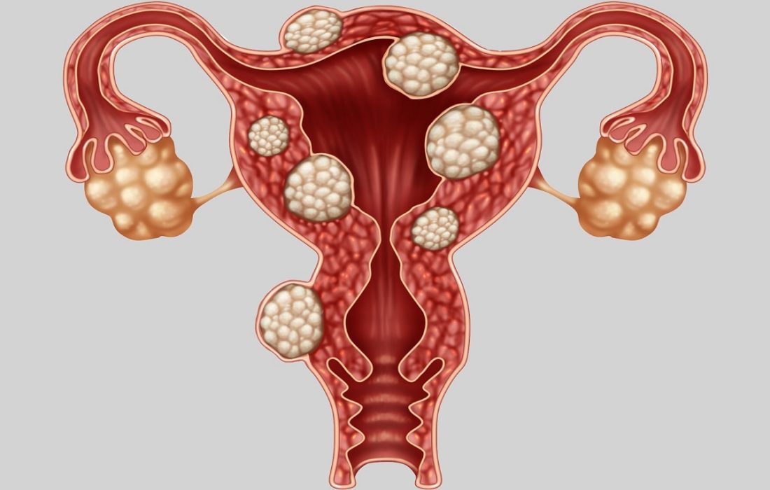 علائم اندومتریوز کدامند؟ نشانه‌های آندومتریوز خفیف و شدید چیست؟