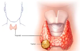 باورهای رایج اما غلط در مورد پرکاری تیروئید