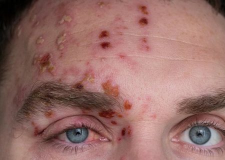 رژیم غذایی برای بیماران مبتلا به زونا