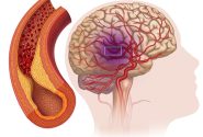 آمبولی مغزی چیست؟
