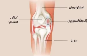 سندروم پلیکا و شناخت بیشتر آن
