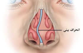 انحراف بینی چیست؟ چه زمانی باید برای درمان اقدام کرد؟