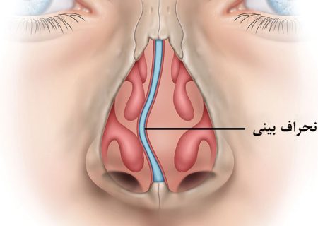 انحراف بینی چیست؟ چه زمانی باید برای درمان اقدام کرد؟