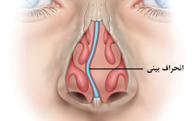 انحراف بینی چیست؟ چه زمانی باید برای درمان اقدام کرد؟
