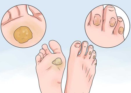 میخچه و پینه چیست و چگونه می‌توان آن‌ها را درمان کرد؟