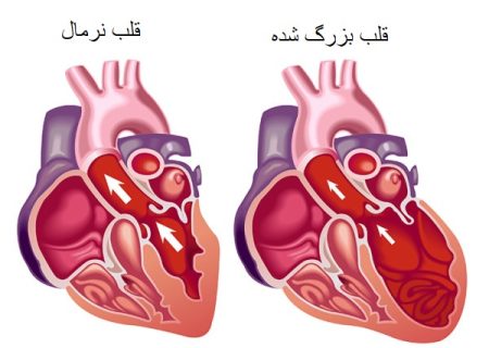 گشادی قلب؛ آشنایی کامل با این بیماری