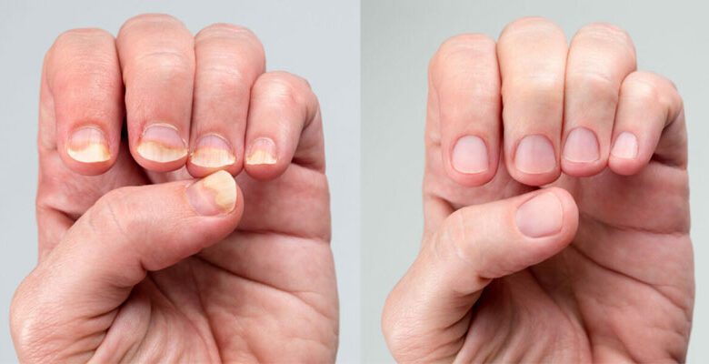 قارچ ناخن چیست؟ علائم، علل و راه درمان آن