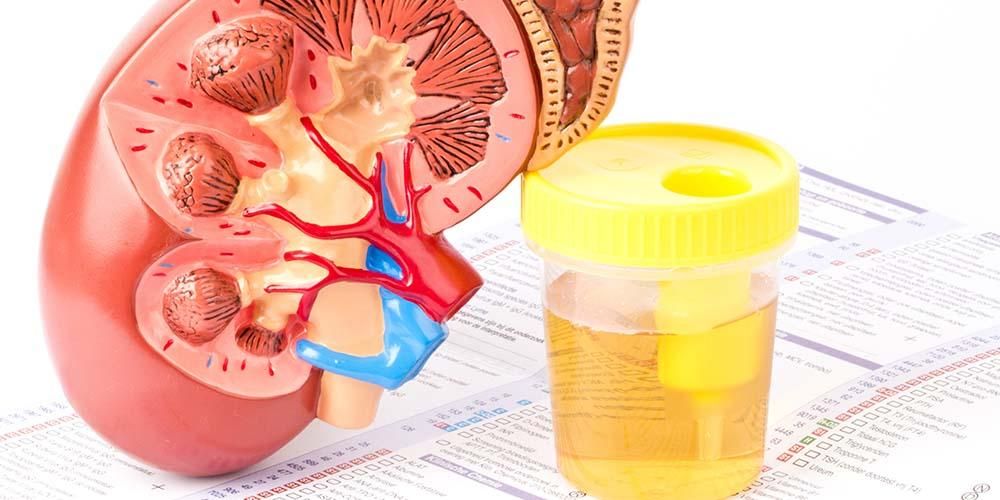 دفع پروتئین در ادرار یا پروتئینوری چیست؟