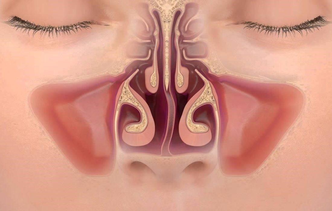 شاخک بینی بزرگ شده یا شکسته را چگونه درمان کنیم؟
