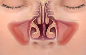 شاخک بینی بزرگ شده یا شکسته را چگونه درمان کنیم؟
