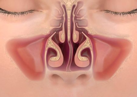 شاخک بینی بزرگ شده یا شکسته را چگونه درمان کنیم؟