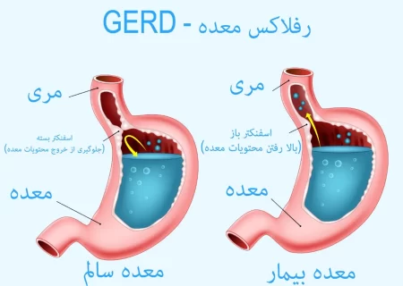 کدام دمنوش برای رفلاکس معده خوب است؟