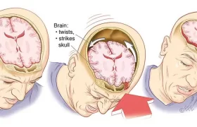 علائم، علل و عوارض ضربه‌ی مغزی