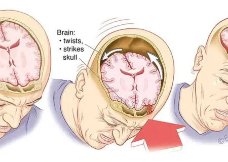 علائم، علل و عوارض ضربه‌ی مغزی
