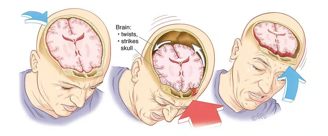 علائم، علل و عوارض ضربه‌ی مغزی