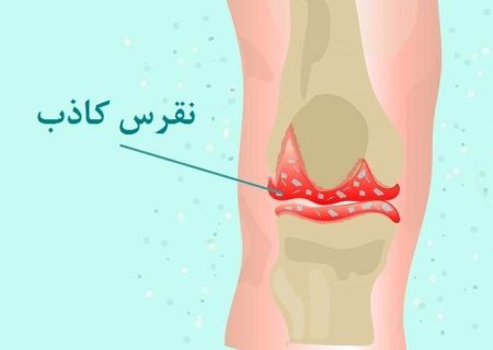 نقرس کاذب چیست؟