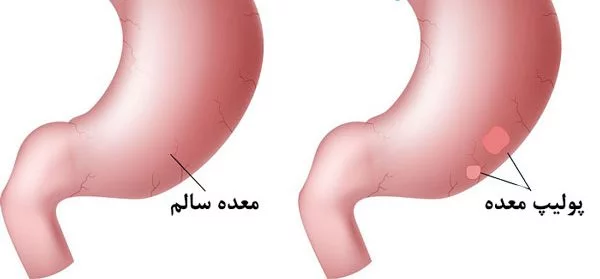 پولیپ معده از چیست؟