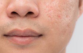 سابسیژن چیست؟ کاربرد، نحوه انجام، عوارض و مدت زمان اثر آن